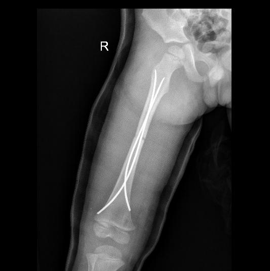 幼儿骨折误区,儿童骨折为什么好得快