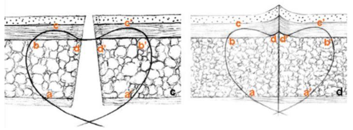 有了疤痕之后多久去除疤痕最好,疤痕痕迹较深怎么消除