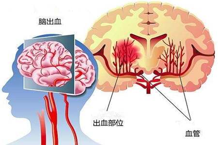 介入治疗血栓,脑静脉窦血栓还可以介入治疗吗