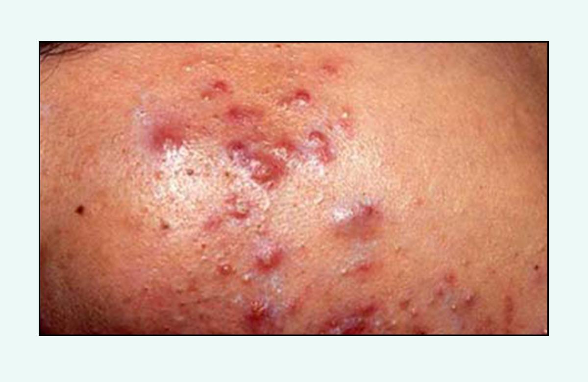 脸上的红疙瘩疼是什么原因,脸上的各种疙瘩