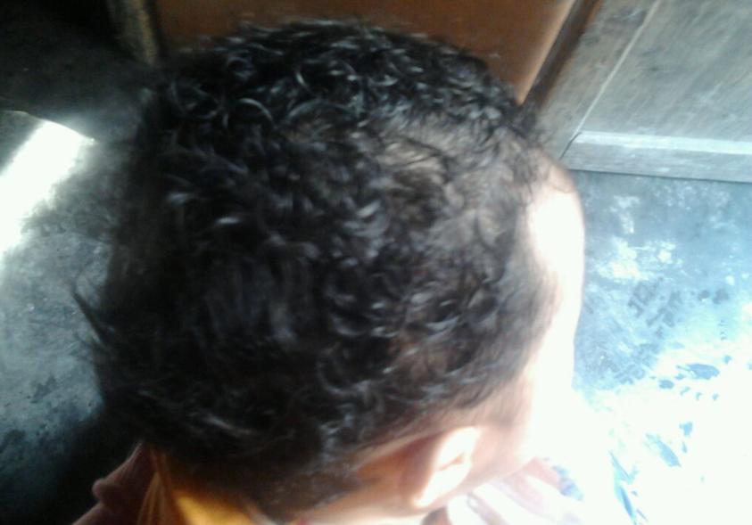 新生儿头发稀少黄是什么原因,出生的新生儿头发黄是什么原因