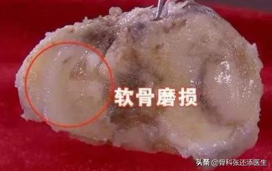 膝关节咔咔响的治疗方法,走路膝关节咔咔咔响是怎样的