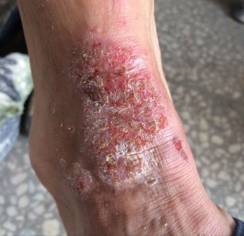 湿疹在中医里面是什么原因引起的,手掌湿疹反复开裂脱皮中医治疗