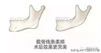 记录翻译小姐姐日本打溶脂针，肉脸变骨感脸全过程｜日本医美