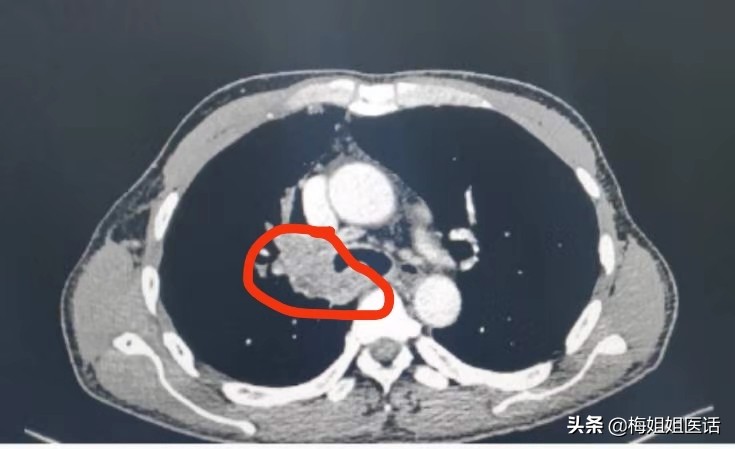 从疾病预防改为健康预防,从中医角度谈谈肿瘤的防治