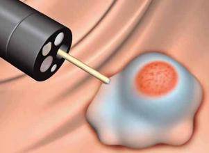 多发息肉和单发息肉哪个容易癌变,分叶息肉和带蒂息肉哪个容易癌变