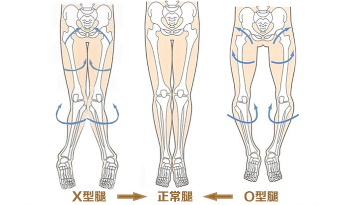 小孩是o型腿图片,孩子x型腿很严重应该怎么解决