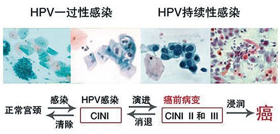 宫颈癌病变预判,宫颈癌前病变ki67阳性70%