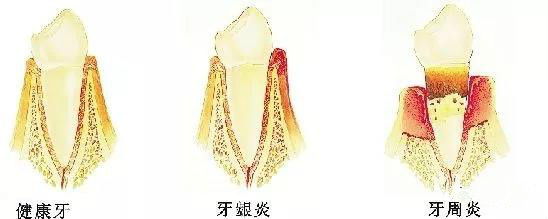 牙齿矫正之七大误区,牙齿矫正这14个副作用你信了几个