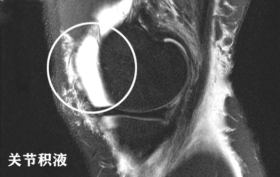 怎样能看懂膝关节核磁图片,如何看懂膝关节磁共振报告