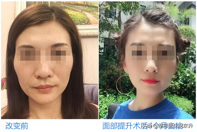 25岁脸垮有皱纹正常吗,面部衰老下垂的症状