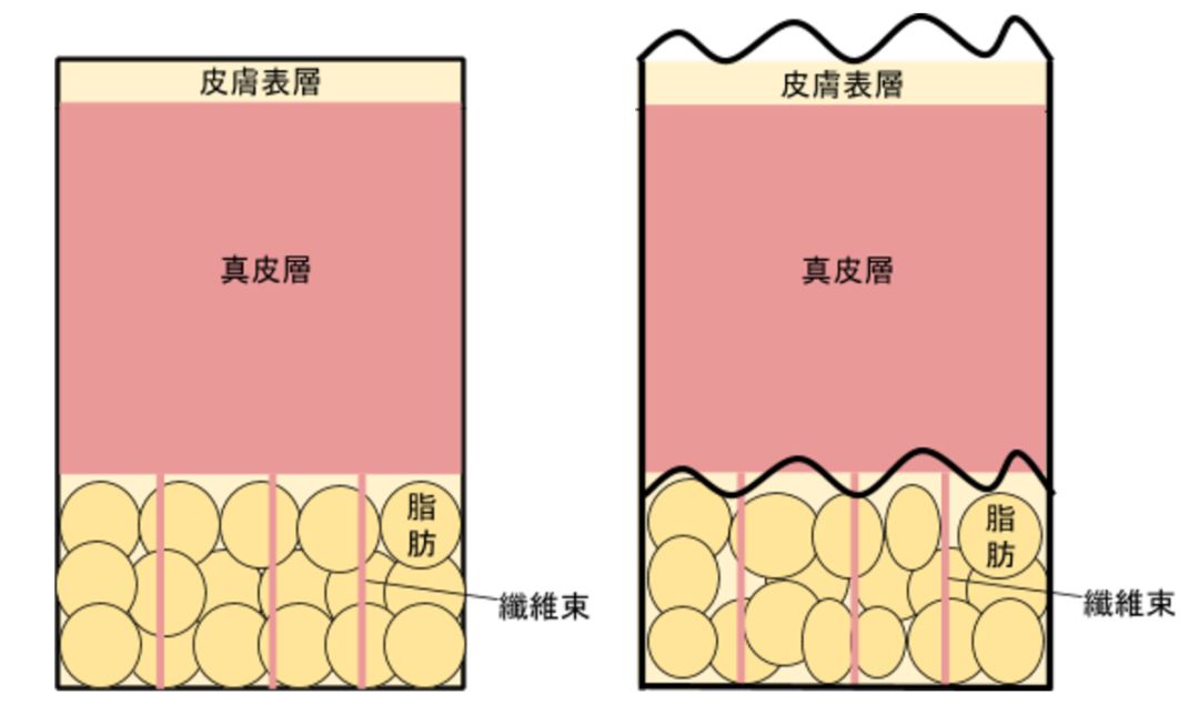 瘦下来橘皮会消失吗,橘皮策划肥胖怎么办