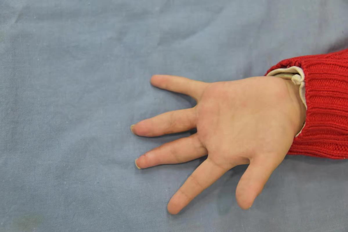 新生儿手指畸形中指食指无名指,婴儿先天性手指畸形中指