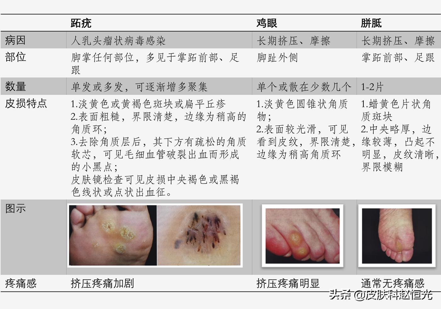 脚上长了个鸡眼它自己会好吗,脚上长的不是鸡眼但是特别疼