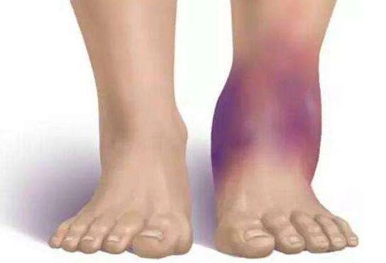 人总是崴脚怎么回事,孩子总爱崴脚怎么回事