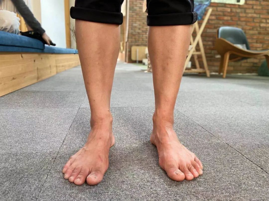 小腿正前方肌肉发达是为什么,小腿外侧发达
