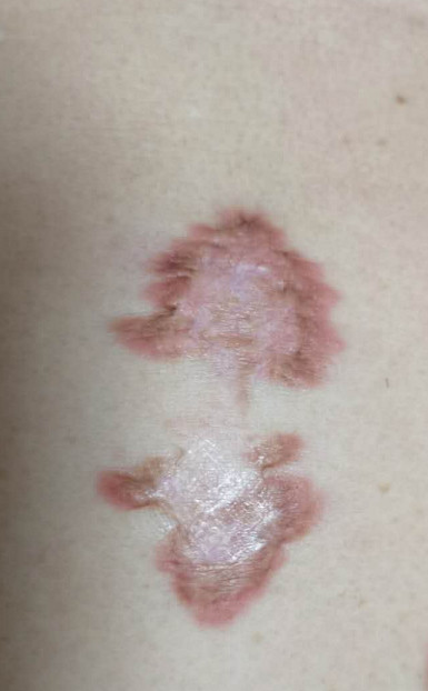 疤痕体质用什么方法祛疤好,欣奕除疤凝胶对疤痕体质有效果吗