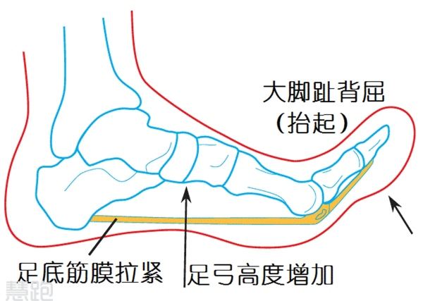 治好足底筋膜炎的一个意外方法,足底筋膜炎严重到无法行走