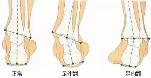 足内翻导致的小腿外翻怎么办,足内翻是怎么样