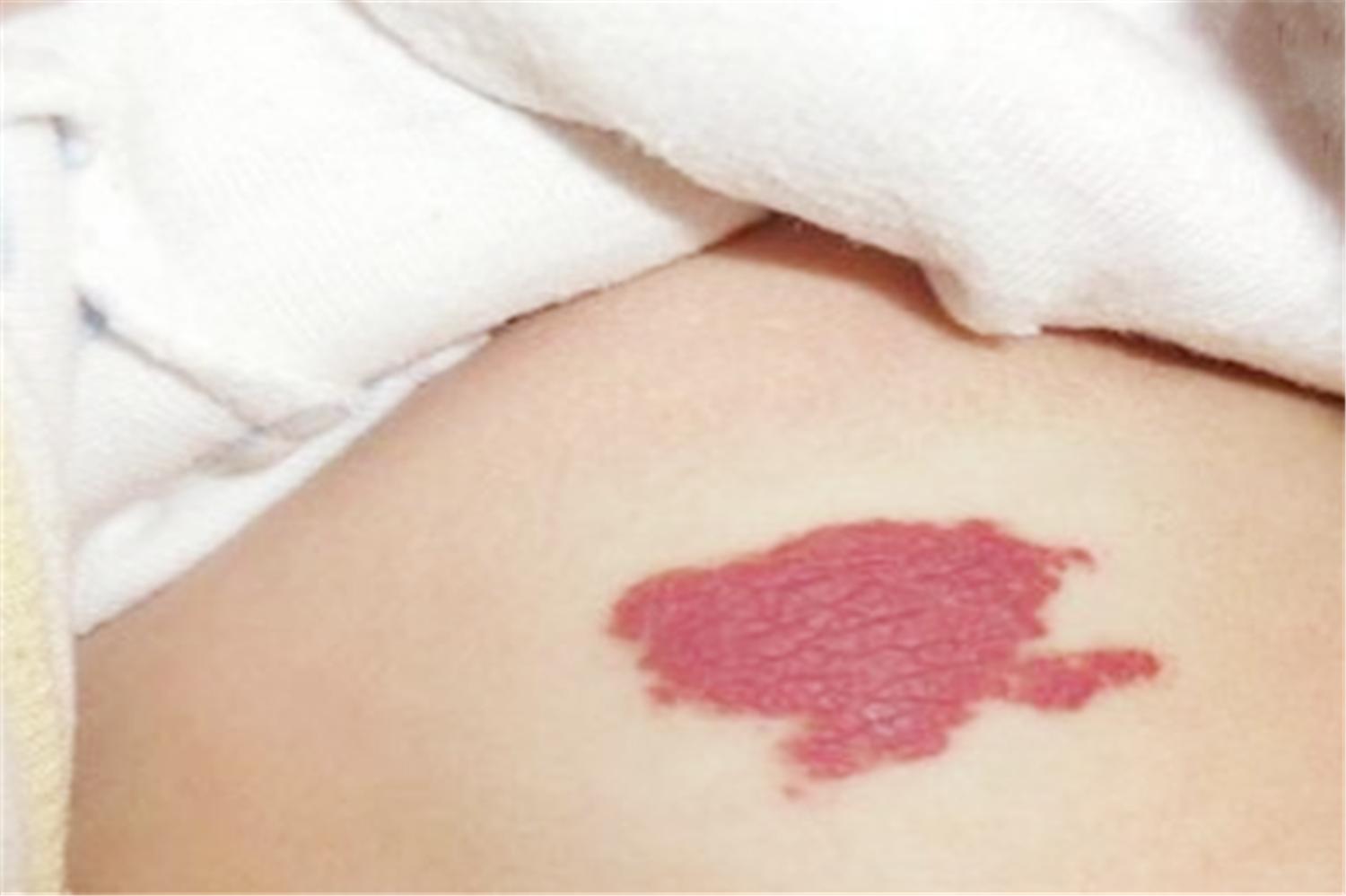 胎儿长胎记是怎么导致的,胎儿容易长胎记的原因是什么