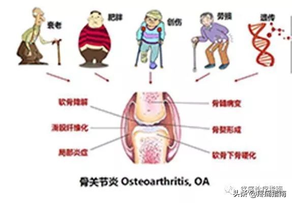 骨性关节炎诊疗方案及流程,骨性关节炎的护理诊断