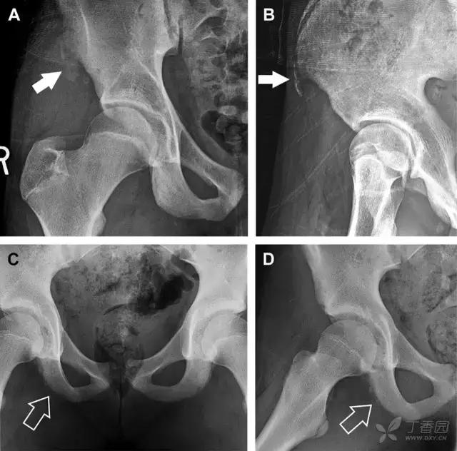 值夜班急救措施,放射科容易漏诊的骨折