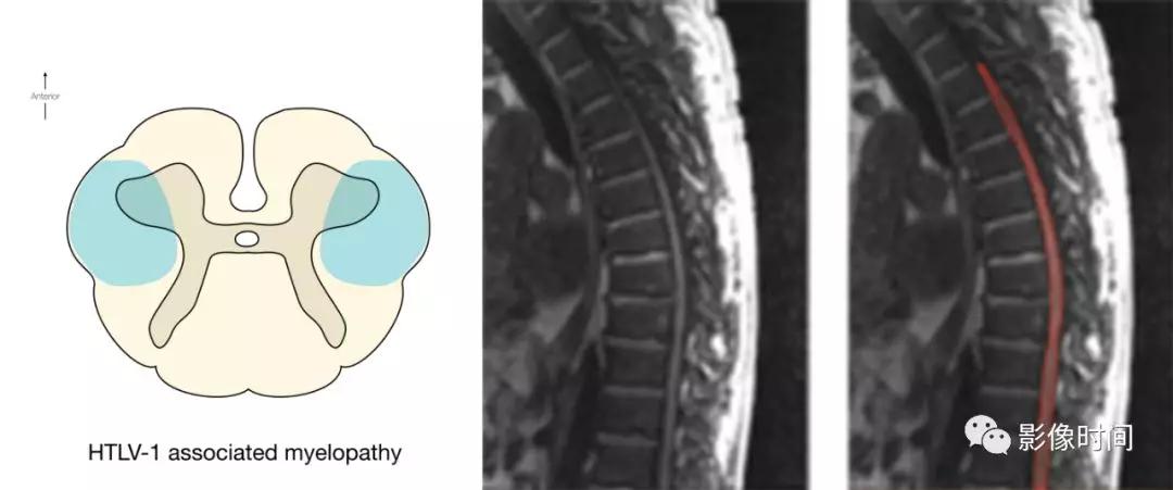 脊髓病变案例图文问诊,脊髓病变视频