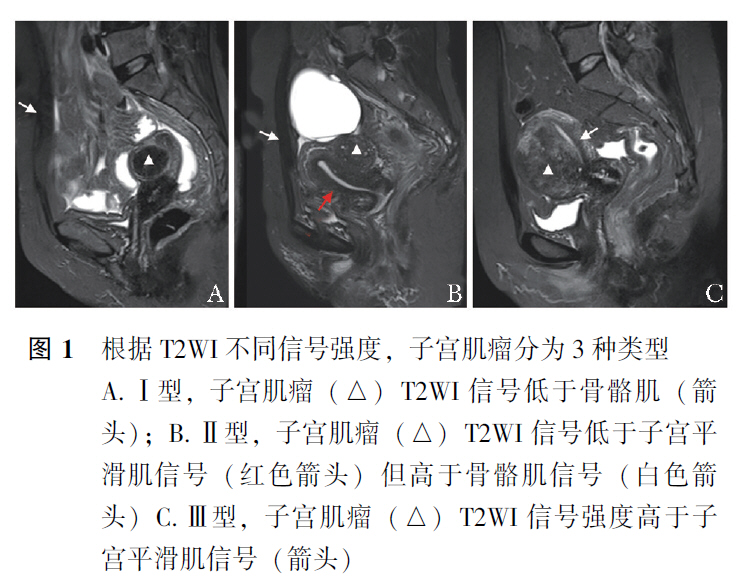 超声聚焦治疗子宫肌瘤的利与弊,mri引导射频消融的优缺点