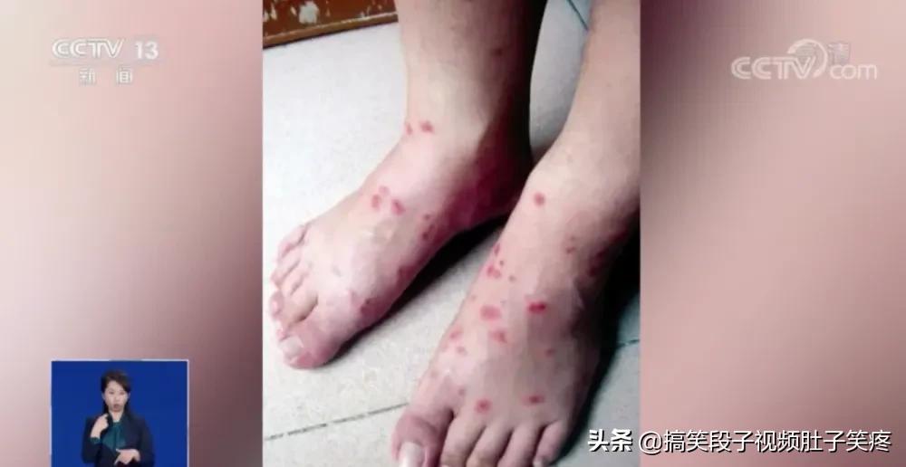 红火蚁咬后什么时候出现症状,红火蚁咬后出现什么症状