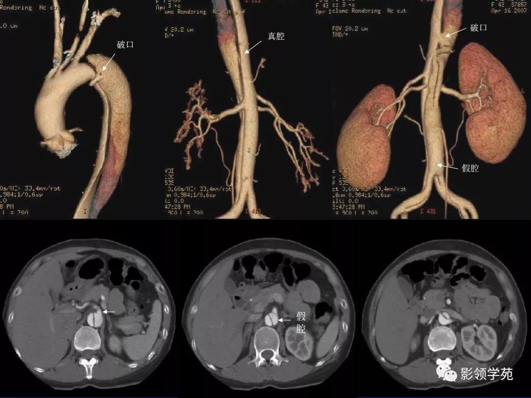 主动脉夹层壁间血肿如何鉴别,主动脉夹层血肿溃疡