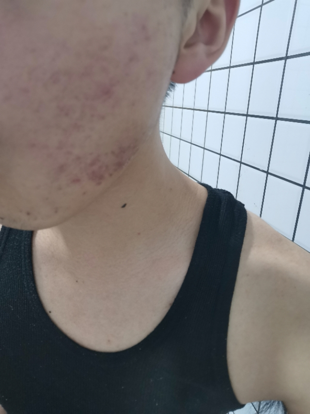 痘印是怎么出来的,痘印是怎么生成的