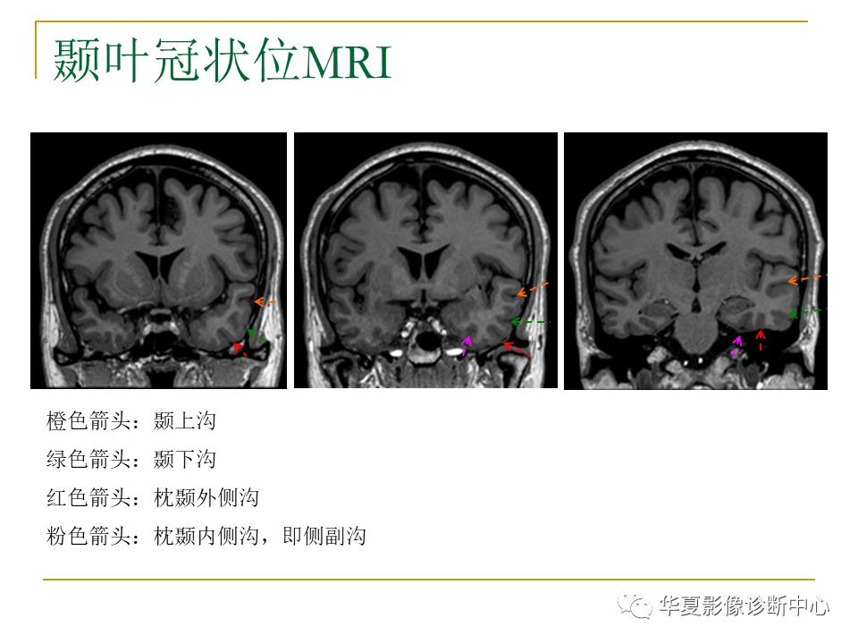 中国人脑立体定向mri应用解剖图谱,脑mri示意图