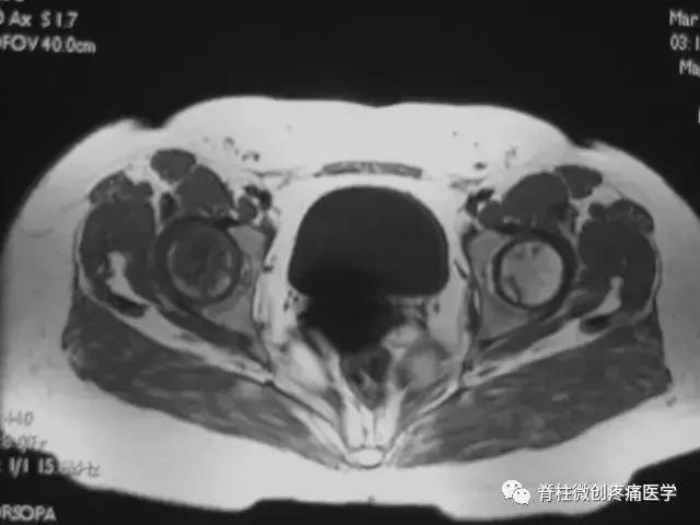 早期股骨头坏死核磁共振怎么看,股骨头坏死磁共振表现及分期
