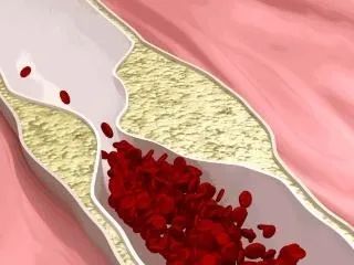 面对一个患有脑梗的怎么去安慰,中医耳道取栓治疗脑梗