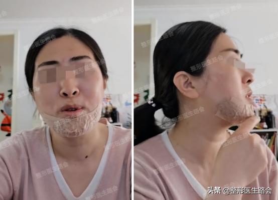 垫下巴手术流程,垫下巴手术的全过程