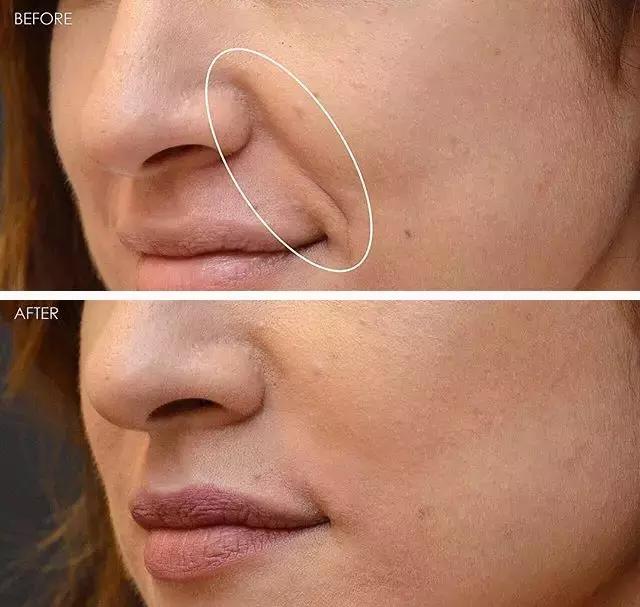 硬刚女皇龙妈也扛不住法令纹，2条沟壑让人心疼，贴一贴就消了