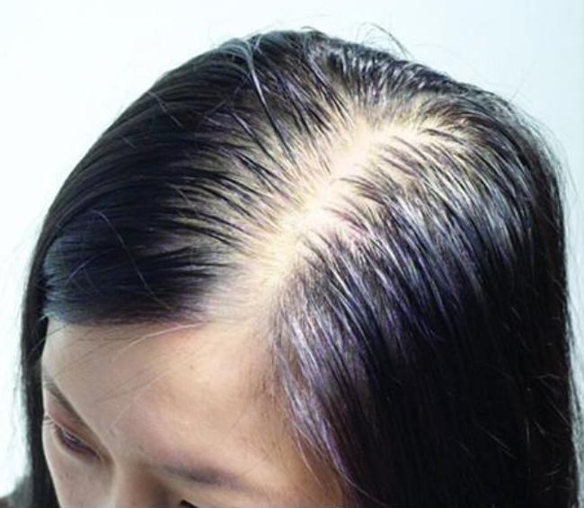 头发为什么越来越细软如何改善,为什么会有特别细软的头发