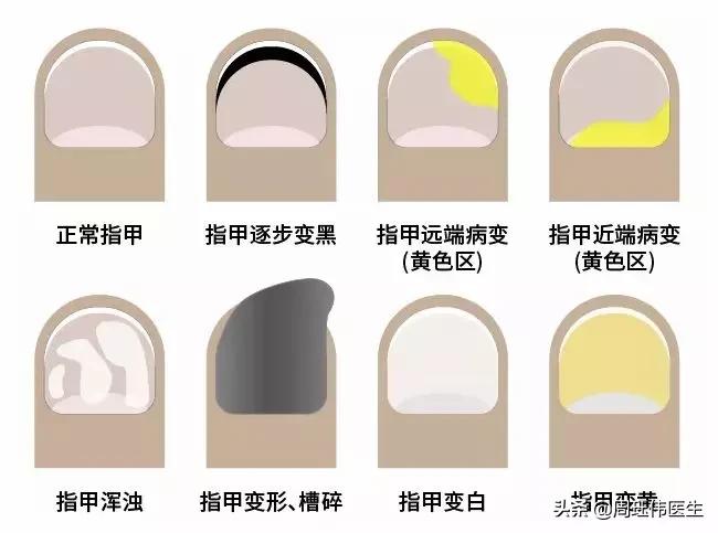 灰指甲和脚气哪个传染性强,疥疮和灰指甲哪个传染性强