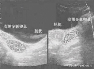 体检b超能查出来多囊卵巢,女性检查出来多囊