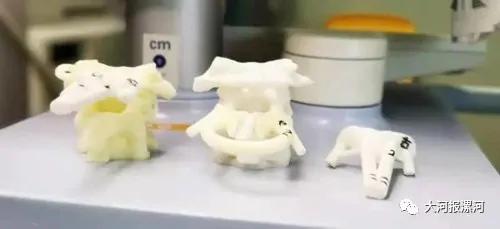 医院用3d打印保住骨肉瘤患者左手,医院3d打印应用