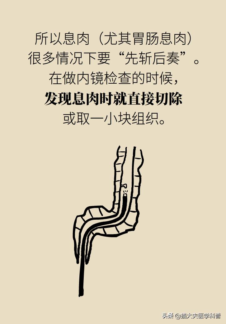 结节囊肿息肉的区别,结节增生囊肿息肉哪种癌前病变