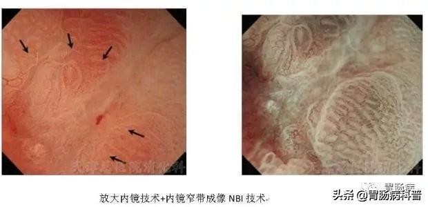 医生做胃镜检查时会看食道的吗,胃镜检查全过程视频消化内科检查