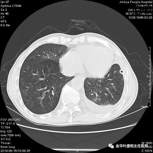手术引起乳糜胸,有没有做了肺结节手术后是误诊的