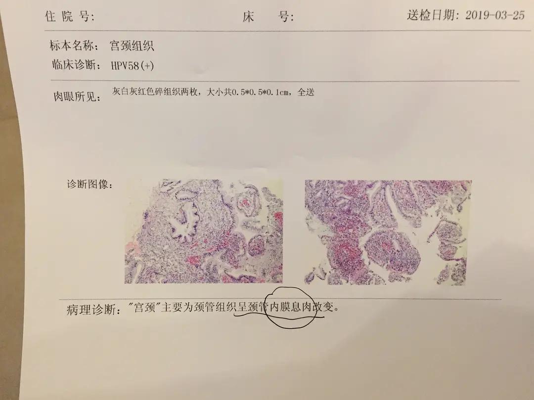 hpv58治疗期间注意事项,hpv58一级病变转阴历程