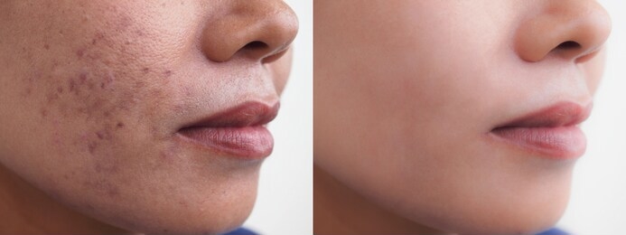 你的痘印是怎么去掉的,很久的痘印该怎么去除