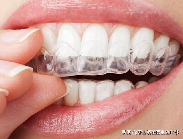 各种牙套的弊端,各种牙套的优缺点是什么