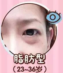 去眼袋15年后有细纹怎么办,祛眼袋之后会不会看着很平