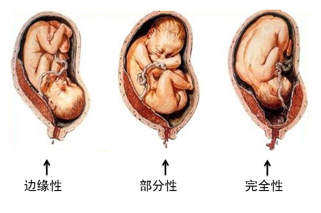 辟谣！胎盘低可不一定是前置胎盘，别吓唬自己