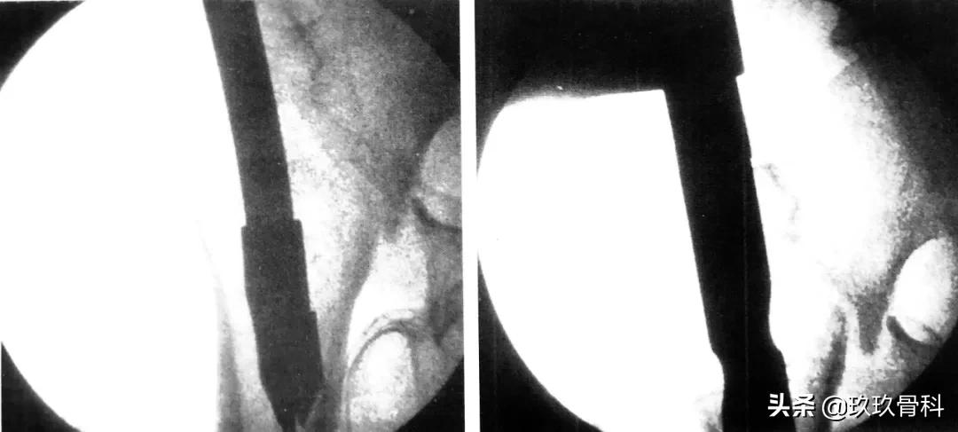 骨科用髓内钉什么材料,骨科髓内钉的作用
