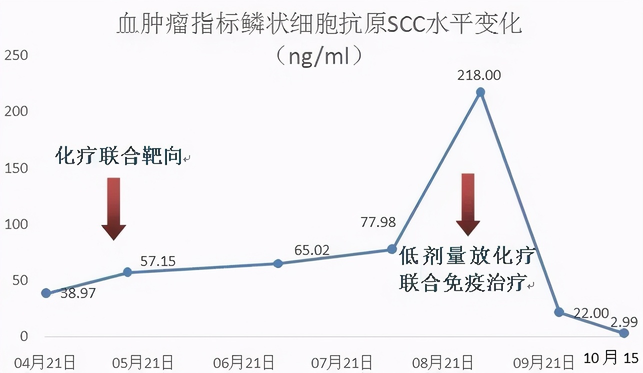 免疫疗法治鳞癌是可单独实施吗,肺转移性鳞癌免疫组化